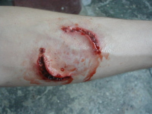 arm, bite, bite mark, blood, human bite