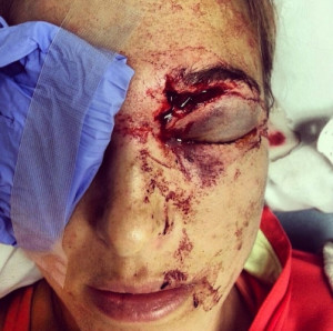 Pro volleyball player Morgan Miller didn’t sustain this nasty injury ...