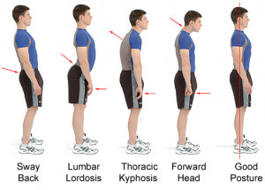 Lordosis, Its cause, Its Implication and Its Correction