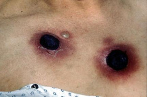 petechial rash pictures leukemia image search results