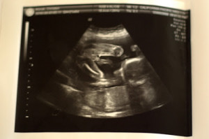 Baby Manak Boy Ultrasound...