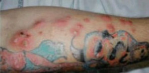 An arm tattoo with a staph infection. This tattoo infection can be ...