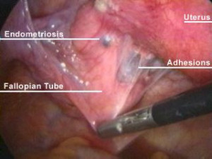 Classic blue-black implants of endometriosis and resulting adhesions ...