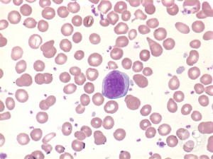 Myelofibrosis Peripheral Blood Smear