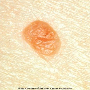 Cancer Moles On Skin