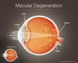 is currently no cure for macular degeneration macular degeneration ...