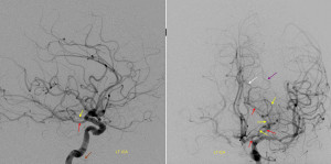 anterior choroidal artery territory