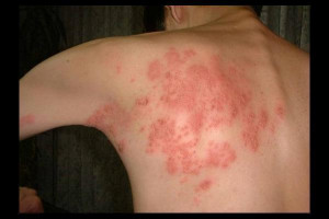 Herpes zoster Picture Slideshow