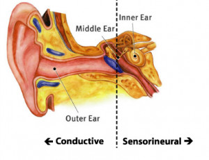 Causes Conductive Hearing Loss