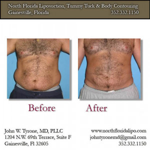 enzymes for liposuction internal scar tissue