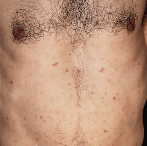 Secondary Syphilis Skin Lesions