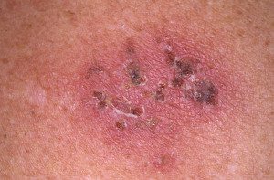 Herpes Zoster Fotografia Din