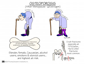 Osteoporosis signs and symptoms.