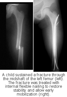 Broken Femur Traction To treat a femur fracture.