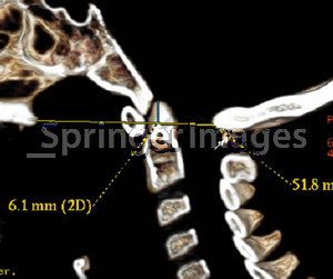 Sagittal 3DCT scan showed unduly long odontoid; Chamberlain’s line ...