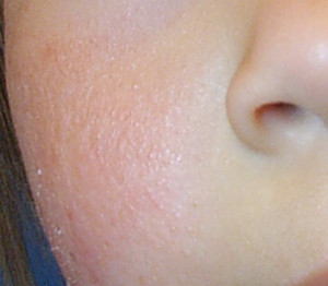 Mild Eczema