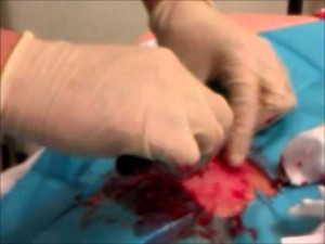 wild ganglion cyst wiki article huge cyst removal warning graphic