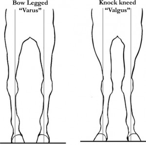 Varus Valgus Knee Deformity