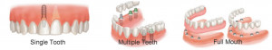 ... quote and dental treatment plan for dental implants, click here