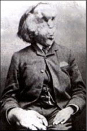 Você conhece Joseph Merrick 