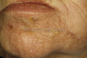 Skin Disease Herpes Zoster
