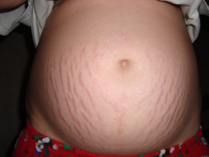... of the women are highly worried about the stretch marks in pregnancy