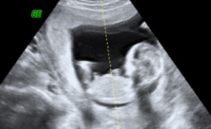 Tech Assistance Please Week Ultrasound Photo Gender