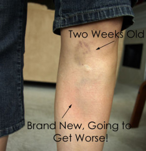 Bruising Medications http://sketchyard.lh.pl/wp-admin/raised-bruise