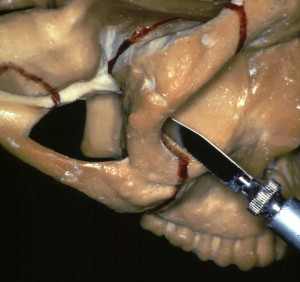 Preauricular Fossa Infratemporal Approach