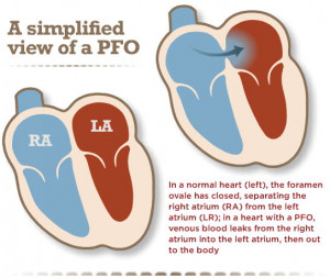 patent foramen ovale in newborn