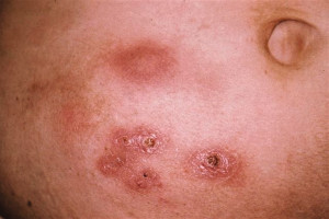 Photos of Diabetic Infection On Skin