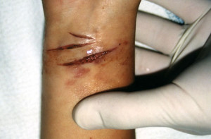 Slit Wrist Suicide Used As A Forensic Evidence Photo picture