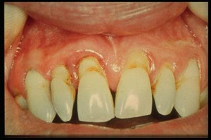 periodontal disease Images and Graphics
