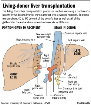 PG graphic: Living-donor liver transplantation