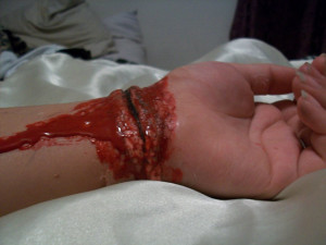 Common ways to commit suicide - Suicide by bleeding