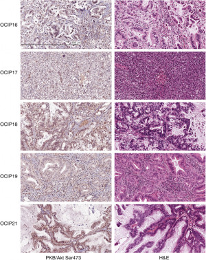 Related Pictures pancreatic cancer stage 4 life expectancy