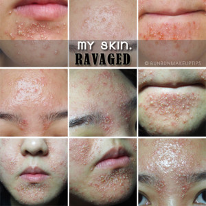 My-Skin-Ravaged-Allergic-Reaction-After-Facial-Experience_day-1-after ...