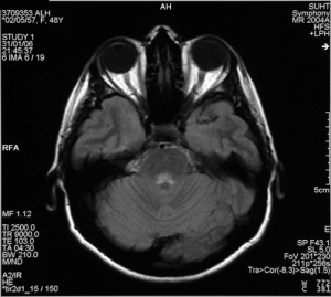 Abnormal MRI Brain Scans