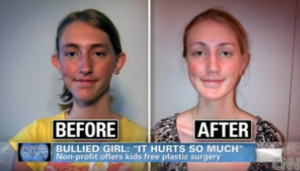 14-year-old Girl Receives Free Plastic Surgery For Her “Deformity”