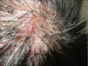 Fungal Folliculitis On Scalp
