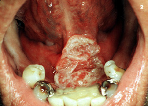 How bad is chewing tobacco?-sc_2_bb.jpg