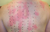 Common Allergy Testing Procedure