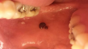 Blood Blister Inside Mouth