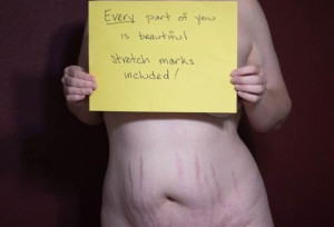 stretch marks#beautiful