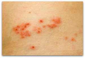 Rmation Shingles Symptoms...