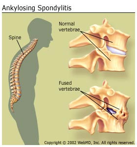 Arthritis and Ankylosing Spondylitis