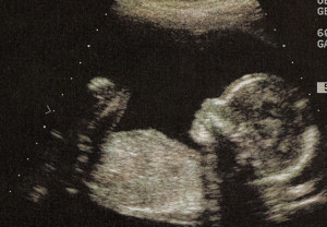 Three Trimester Twins Ultrasound Photos