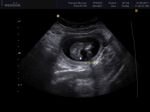 Week Ultrasound What You Think