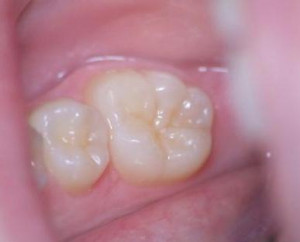what does a cavity look like on a tooth