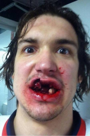 Mitch Callahan perdeu dentes depois de ser atingido por um disco Foto ...